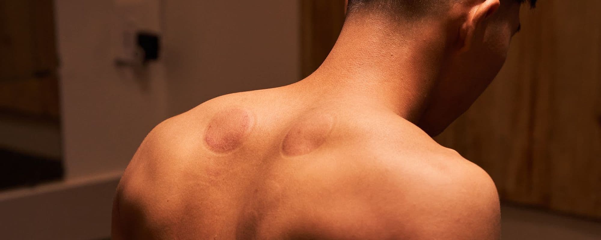 Dấu giác hơi trên vai sau buổi trị liệu